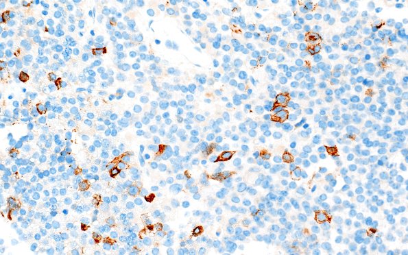 8E Adenoma, GH (Case 8) Prolactin 40X