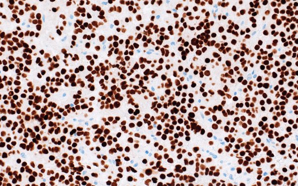 8F2 Adenoma, GH (Case 8) Pit-1 40X