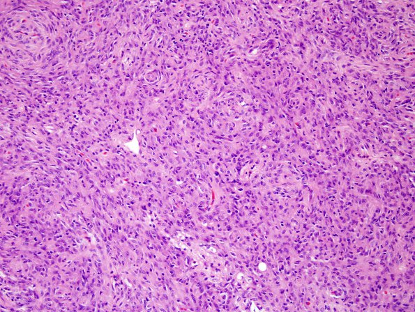 1A1 Pituicytoma (Case 1) H&E 8.jpg