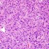 1A2 Pituicytoma (Case 1) H&E 9.jpg