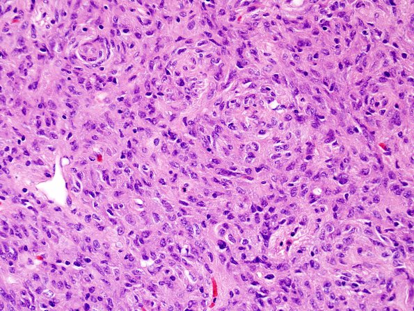 1A2 Pituicytoma (Case 1) H&E 9.jpg