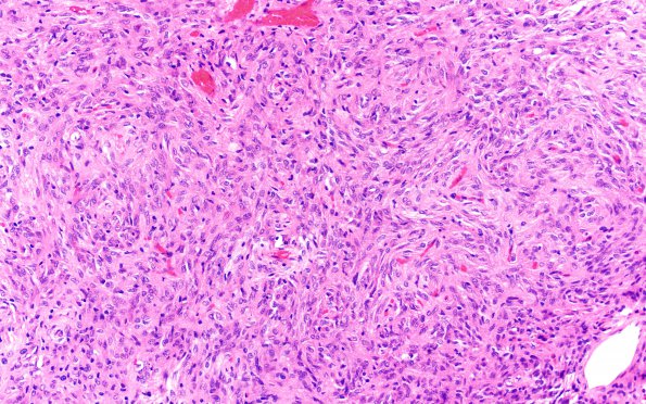 1A3 Pituicytoma (Case 1) 20X