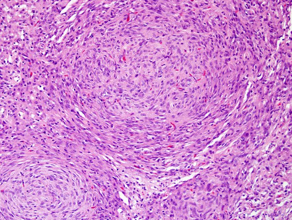 1A4 Pituicytoma (Case 1) H&E 1.jpg