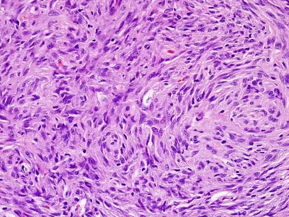 1A5 Pituicytoma (Case 1) H&E 6.jpg