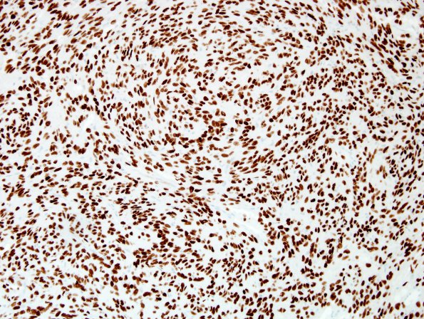 1B Pituicytoma (Case 1) TTF-1.jpg