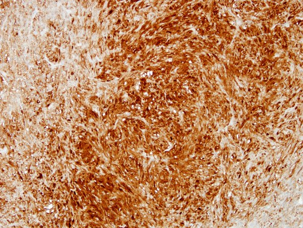 1C1 Pituicytoma (Case 1) S100 2.jpg