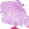 2A1 Pituicytoma (Case 2) H&E 14.jpg