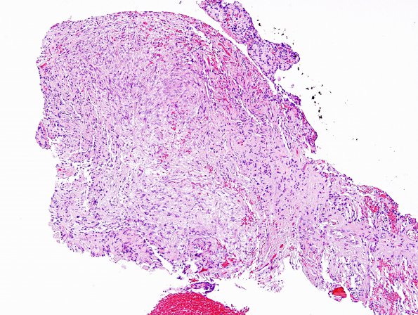 2A1 Pituicytoma (Case 2) H&E 14.jpg