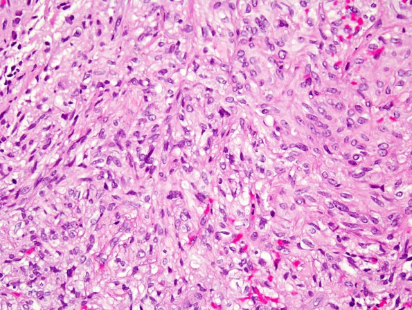 2A2 Pituicytoma (Case 2) H&E 2.jpg