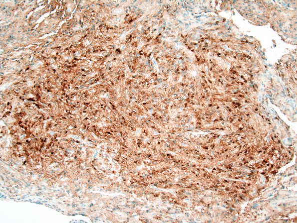 2B1 Pituicytoma (Case 2) S-100 1.jpg