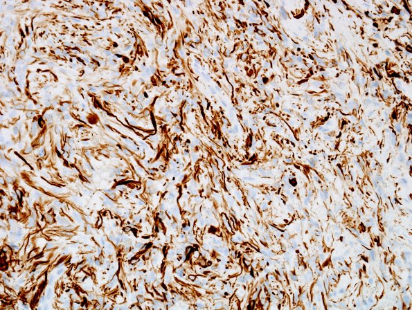 2C3 Pituicytoma (Case 2) GFAP 4.jpg