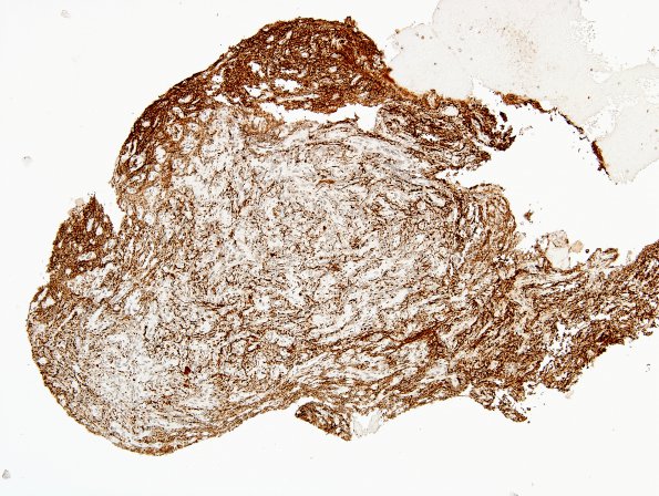 2D1 Pituicytoma (Case 2) SYN 7.jpg