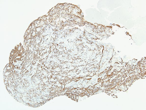 2D2 Pituicytoma (Case 2) NF 2.jpg