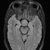 3A1 TTF1 Pituicytoma (Case 3) FLAIR - Copy