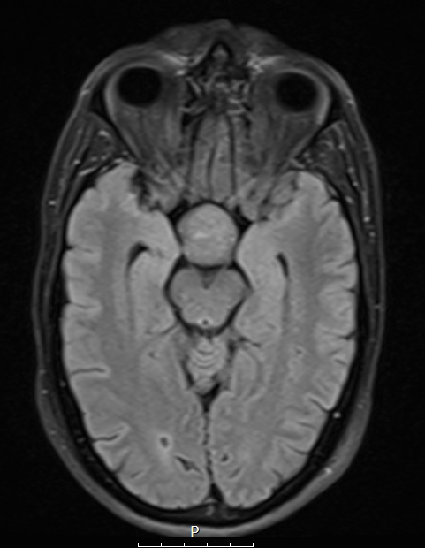 3A1 TTF1 Pituicytoma (Case 3) FLAIR - Copy