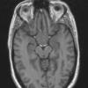 3A2 TTF1 Pituicytoma (Case 3) T1noC - Copy