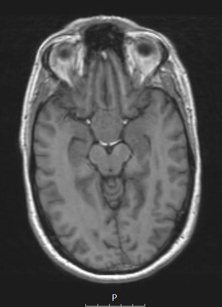 3A2 TTF1 Pituicytoma (Case 3) T1noC - Copy