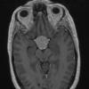 3A4 TTF1 Pituicytoma (Case 3) T1W - Copy