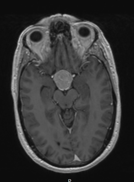 3A4 TTF1 Pituicytoma (Case 3) T1W - Copy