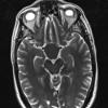 3A5 TTF1 Pituicytoma (Case 3) T2 - Copy