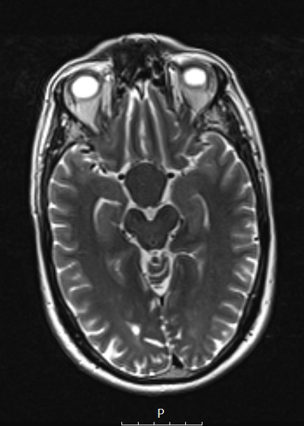 3A5 TTF1 Pituicytoma (Case 3) T2 - Copy