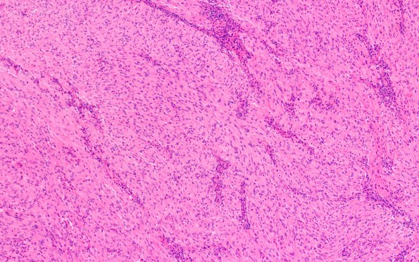 3B1 TTF1 Pituicytoma (Case 3) H&E 10X