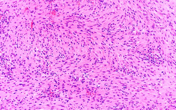 3B2 TTF1 Pituicytoma (Case 3) H&E 20X 4 spindled area