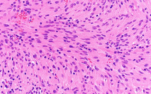 3B3 TTF1 Pituicytoma (Case 3) H&E 40X 6 spindled area