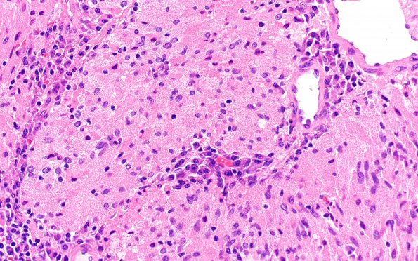 3B4 TTF1 Pituicytoma (Case 3) H&E 40X 3