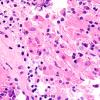 3B5 TTF1 Pituicytoma (Case 3) H&E 60X