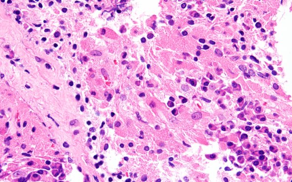 3B5 TTF1 Pituicytoma (Case 3) H&E 60X