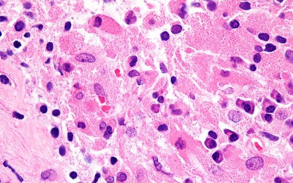 3B6 TTF1 Pituicytoma (Case 3) H&E 100X 1