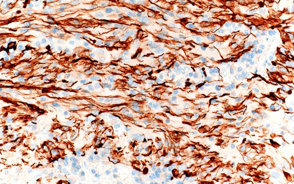 3C1 TTF1 Pituicytoma (Case 3) GFAP 20X 1