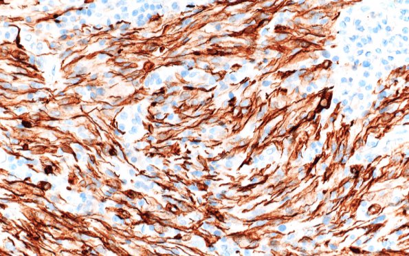 3C2 TTF1 Pituicytoma (Case 3) GFAP 20X 2