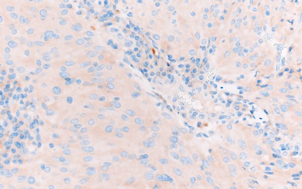 3F TTF1 Pituicytoma (Case 3) SYN 40X