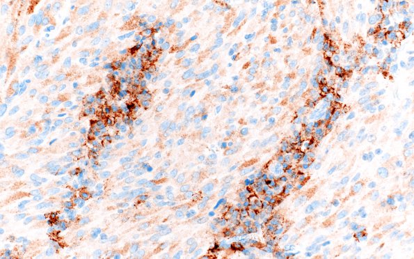 3G TTF1 Pituicytoma (Case 3) EMA 40X