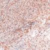 3K1 TTF1 Pituicytoma (Case 3) CD163 10X