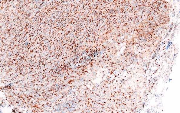 3K1 TTF1 Pituicytoma (Case 3) CD163 10X