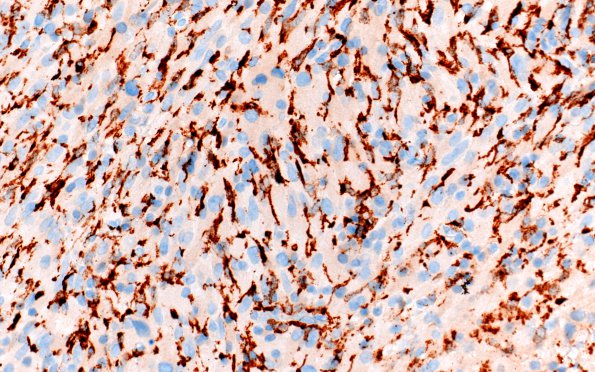 3K2 TTF1 Pituicytoma (Case3) CD163 40X