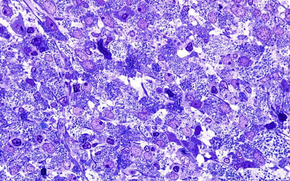 3O1 TTF1 Pituicytoma (Case 3) Plastic 100X 1