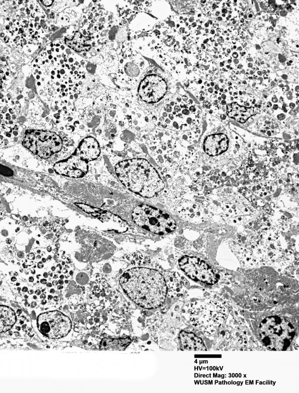 3P1 W23-2669 Skinner H (Case 3) Brain tumor_025 - Copy