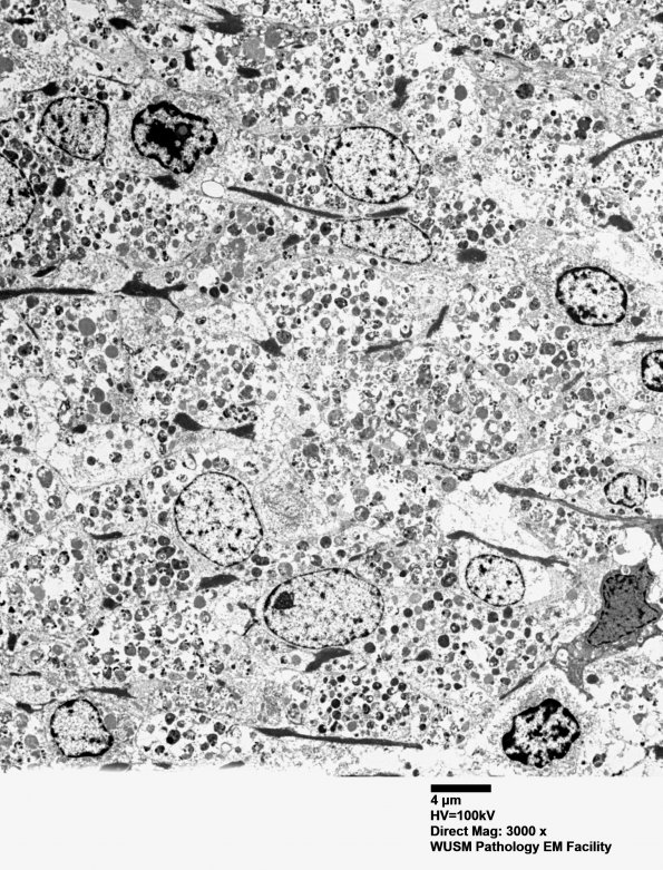 3P2 W23-2669 Skinner H (Case 3) Brain tumor_026 - Copy