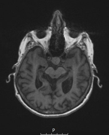 1A1 Spindle cell Oncocytoma (Case 1) T1noC A - Copy