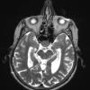 1A3 Spindle cell Oncocytoma (Case 1) T2 A - Copy