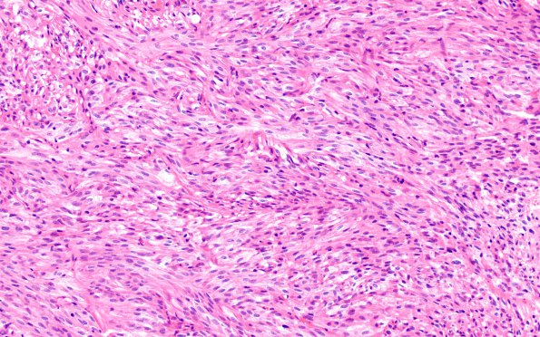 1C1 Spindle cell Oncocytoma (Case 1) H&E 15