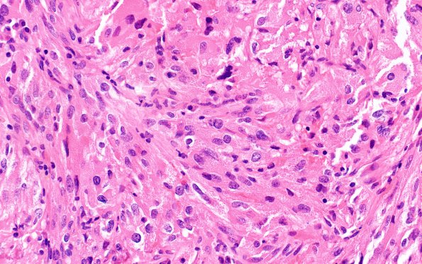 1C2 Spindle cell Oncocytoma (Case 1) H&E 3