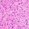 1C3 Spindle cell Oncocytoma (Case 1) H&E 1