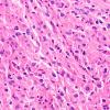 1C4 Spindle cell Oncocytoma (Case 1) H&E 2