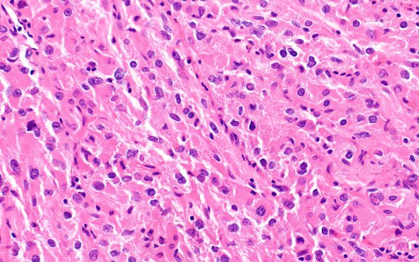 1C4 Spindle cell Oncocytoma (Case 1) H&E 2