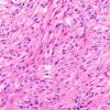 1C5 Spindle cell Oncocytoma (NP19-71) H&E 5